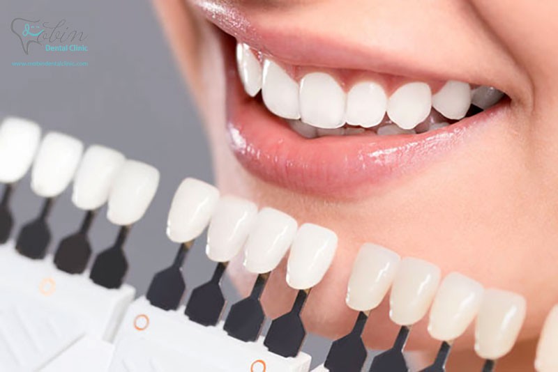 شناخت ویژگی های کامپوزیت دندان